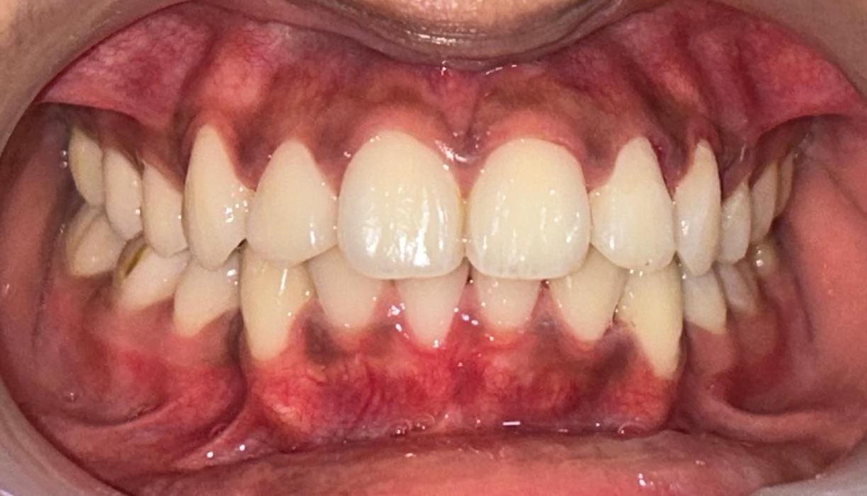 After treatment - close-up view