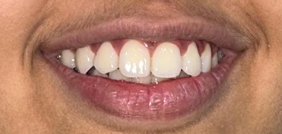 After treatment - smile view