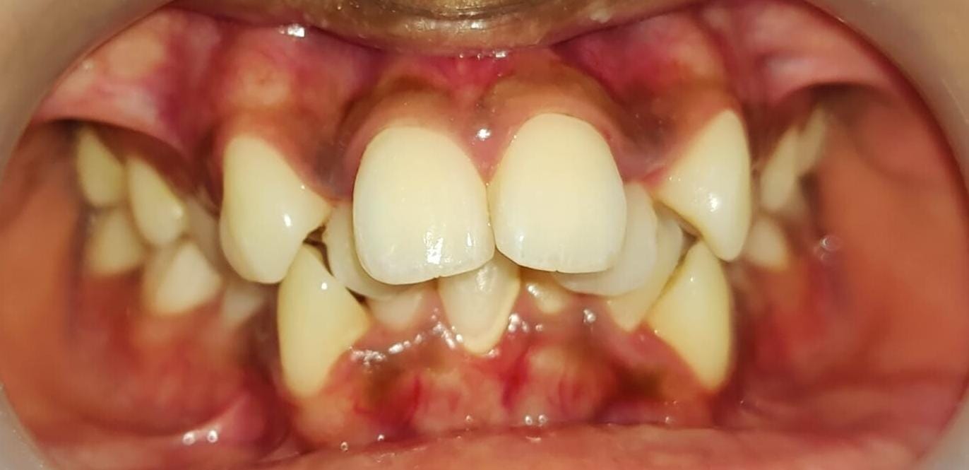 Before treatment - close-up view
