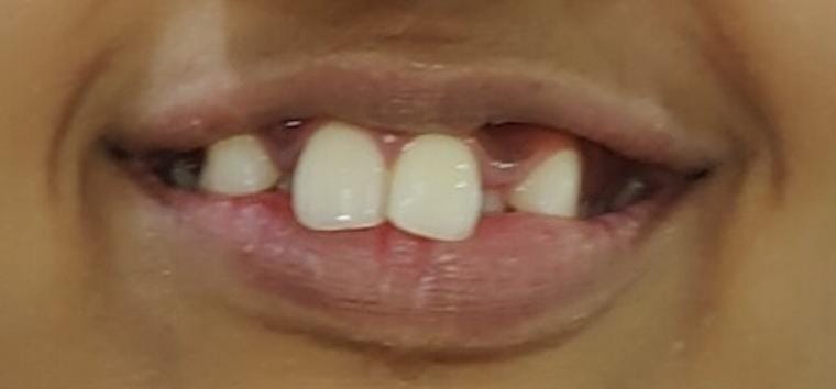 Before treatment - smile view