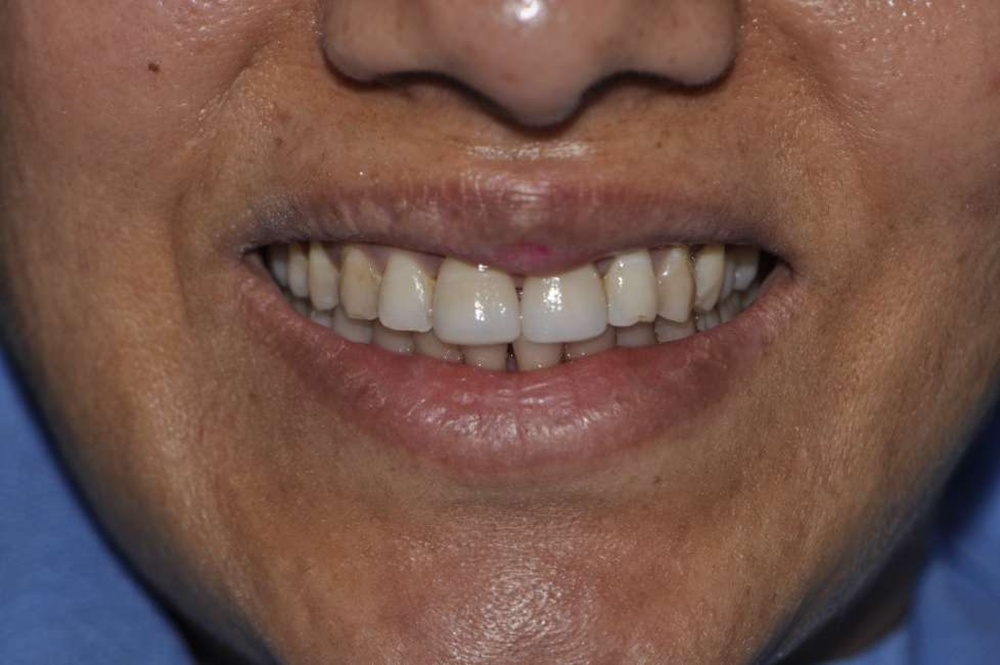 Patient 4 After