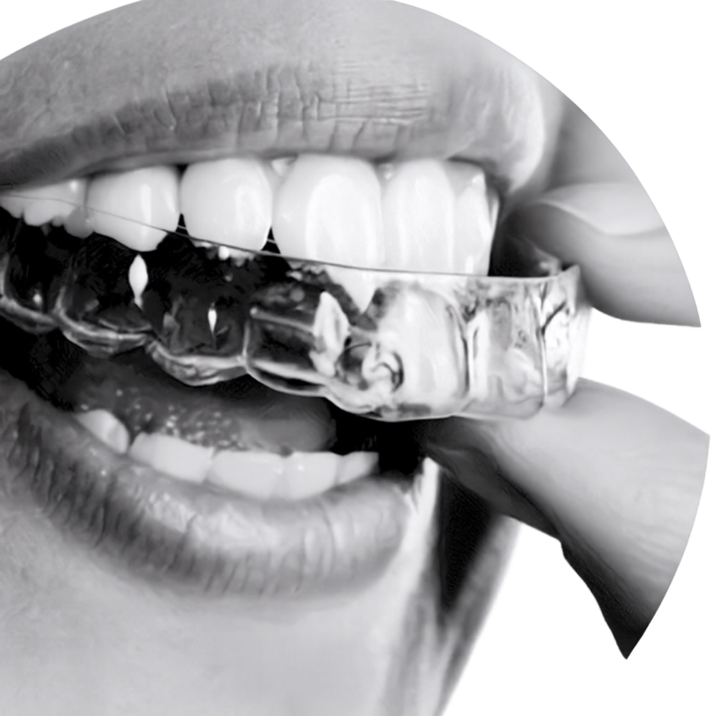 Clear Aligner Smile
