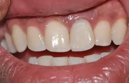 After Dental Treatment