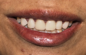 After treatment