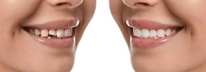 Smile Design