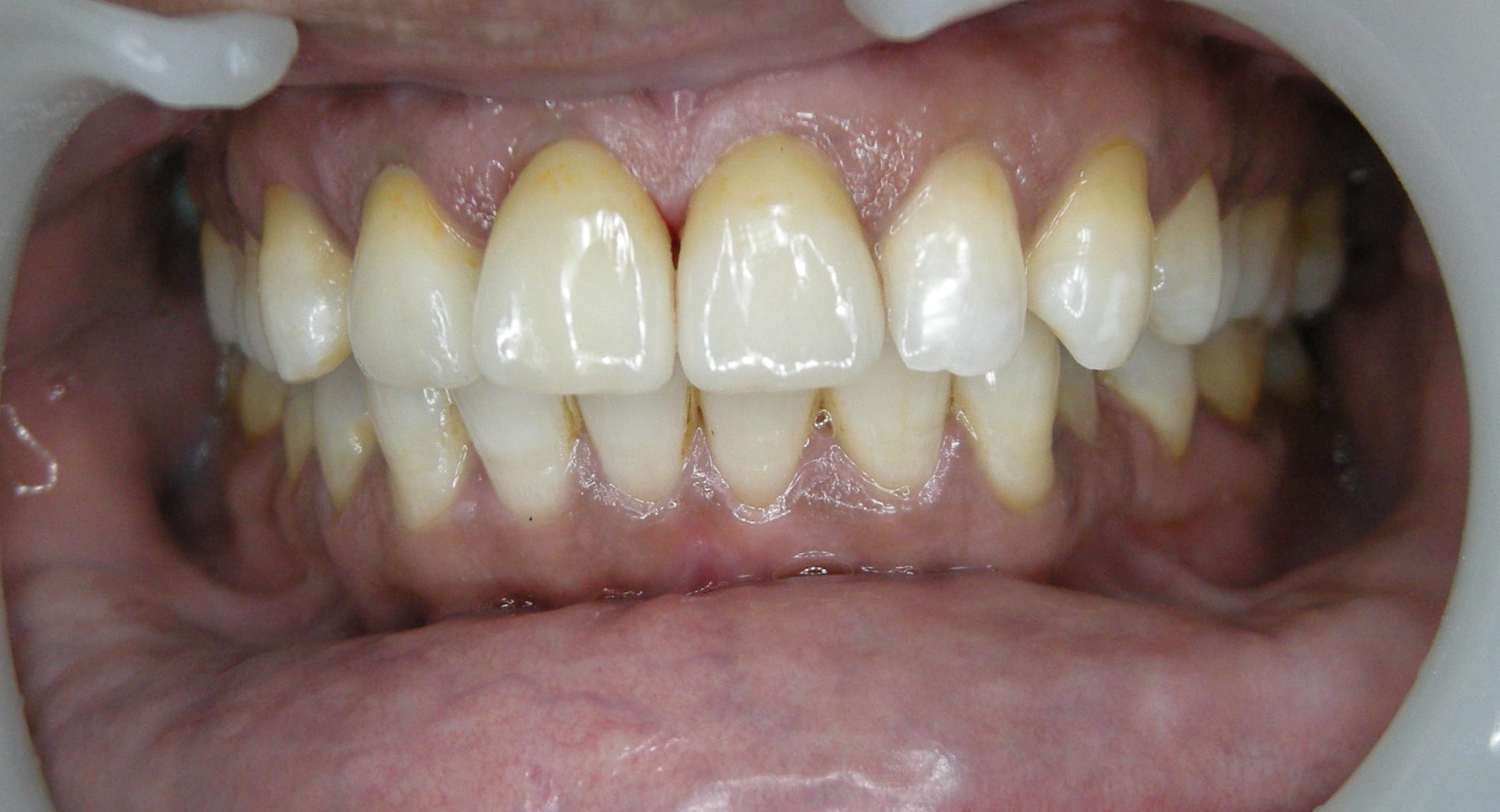 Invisible Braces After