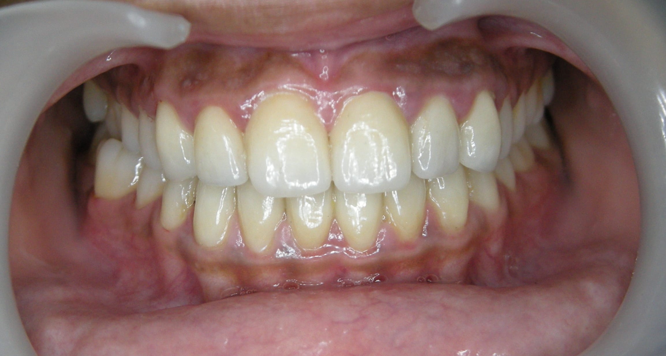 Invisible Braces After