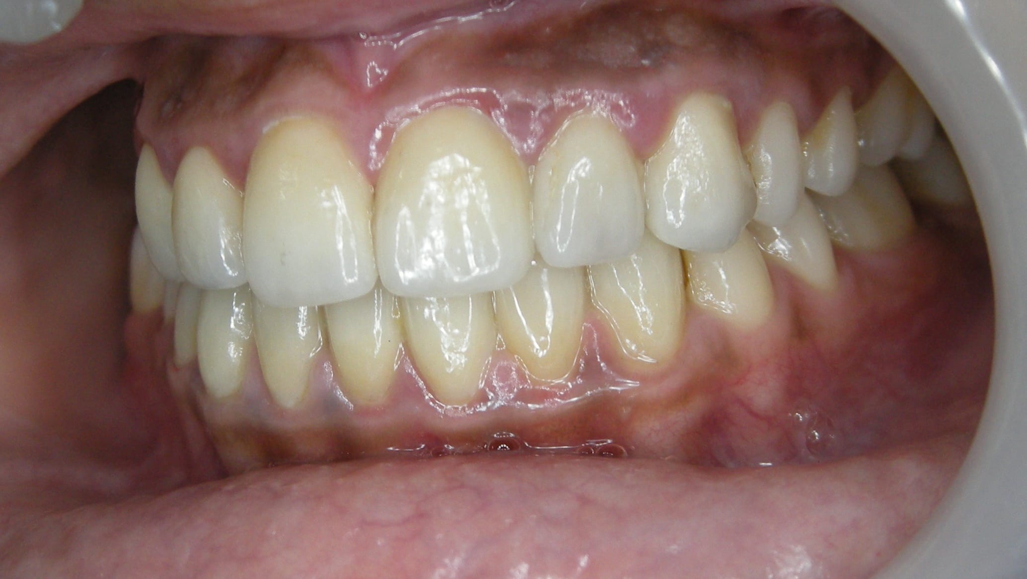 Invisible Braces After
