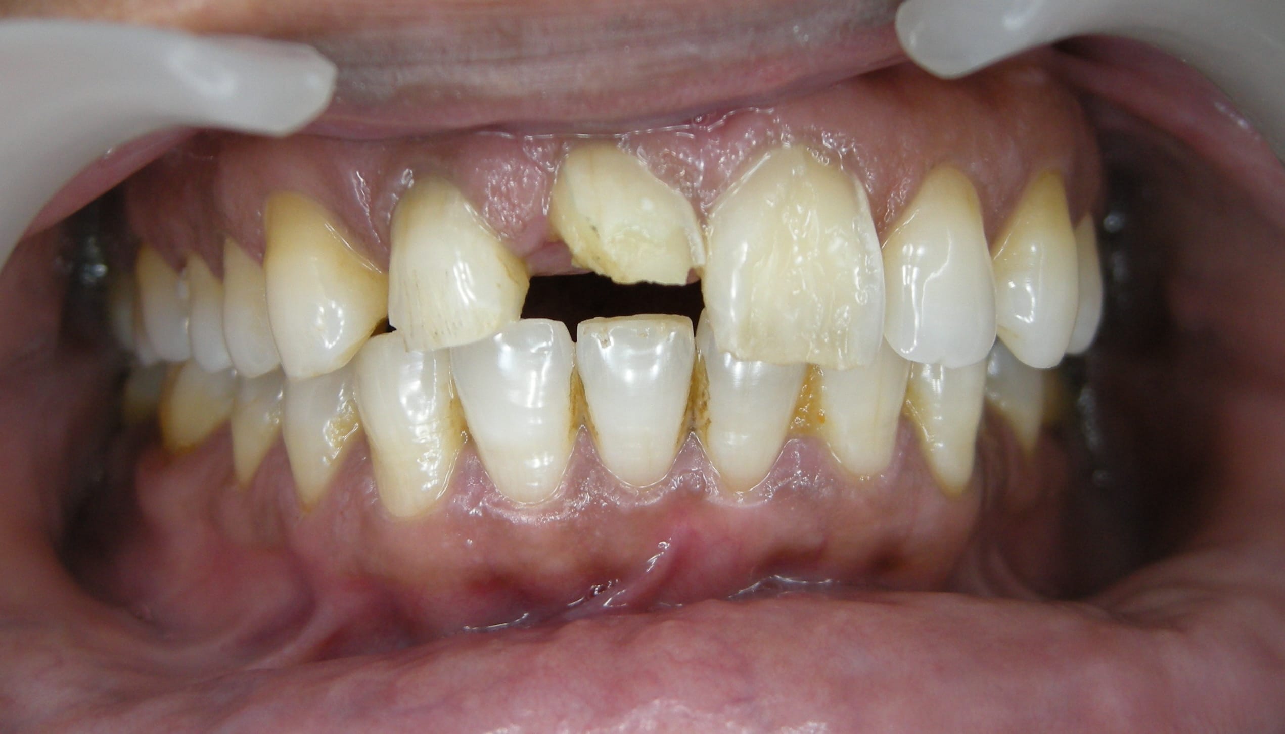 Invisible Braces Before