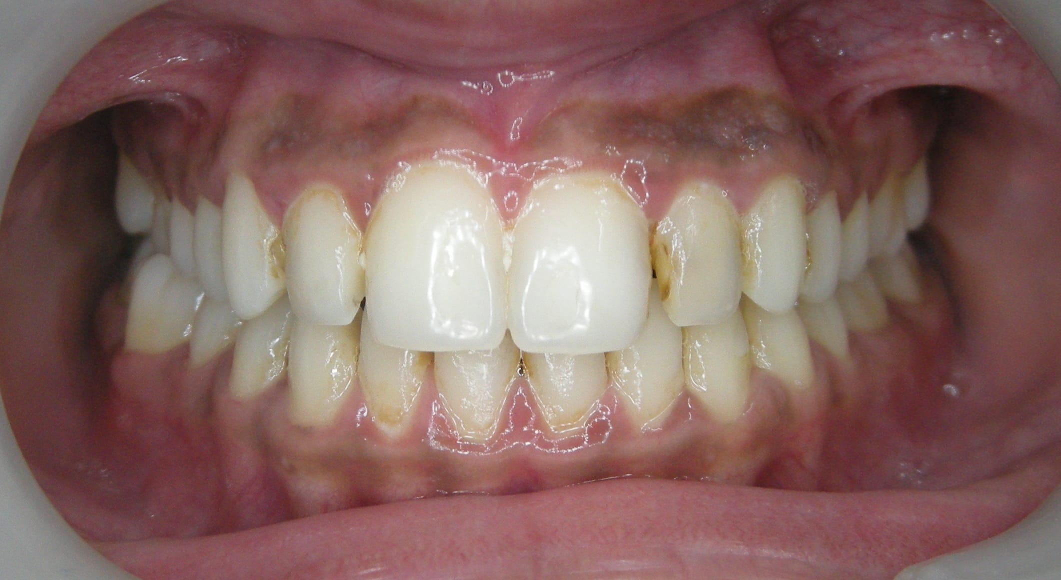 Invisible Braces Before