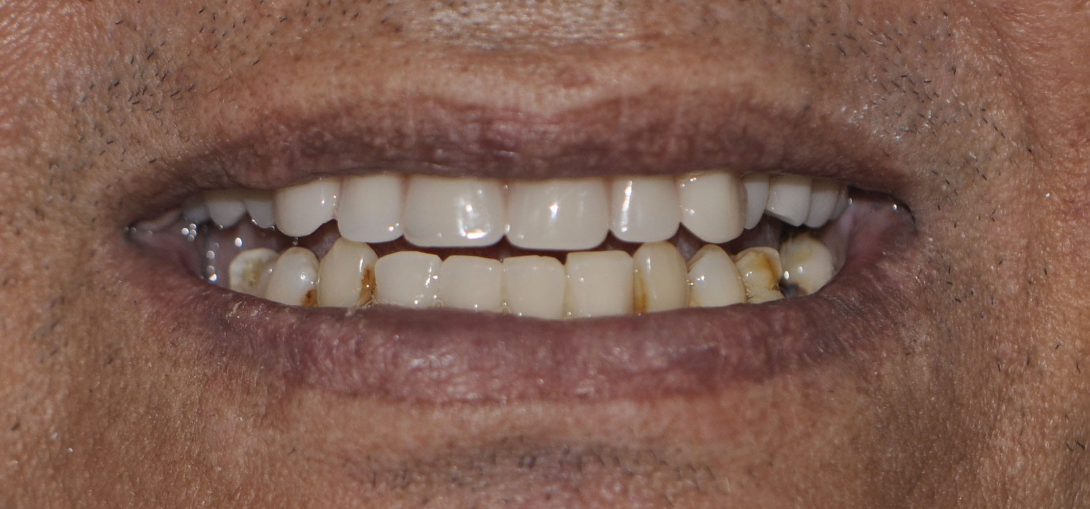 all on 4 dental implants after pic 2