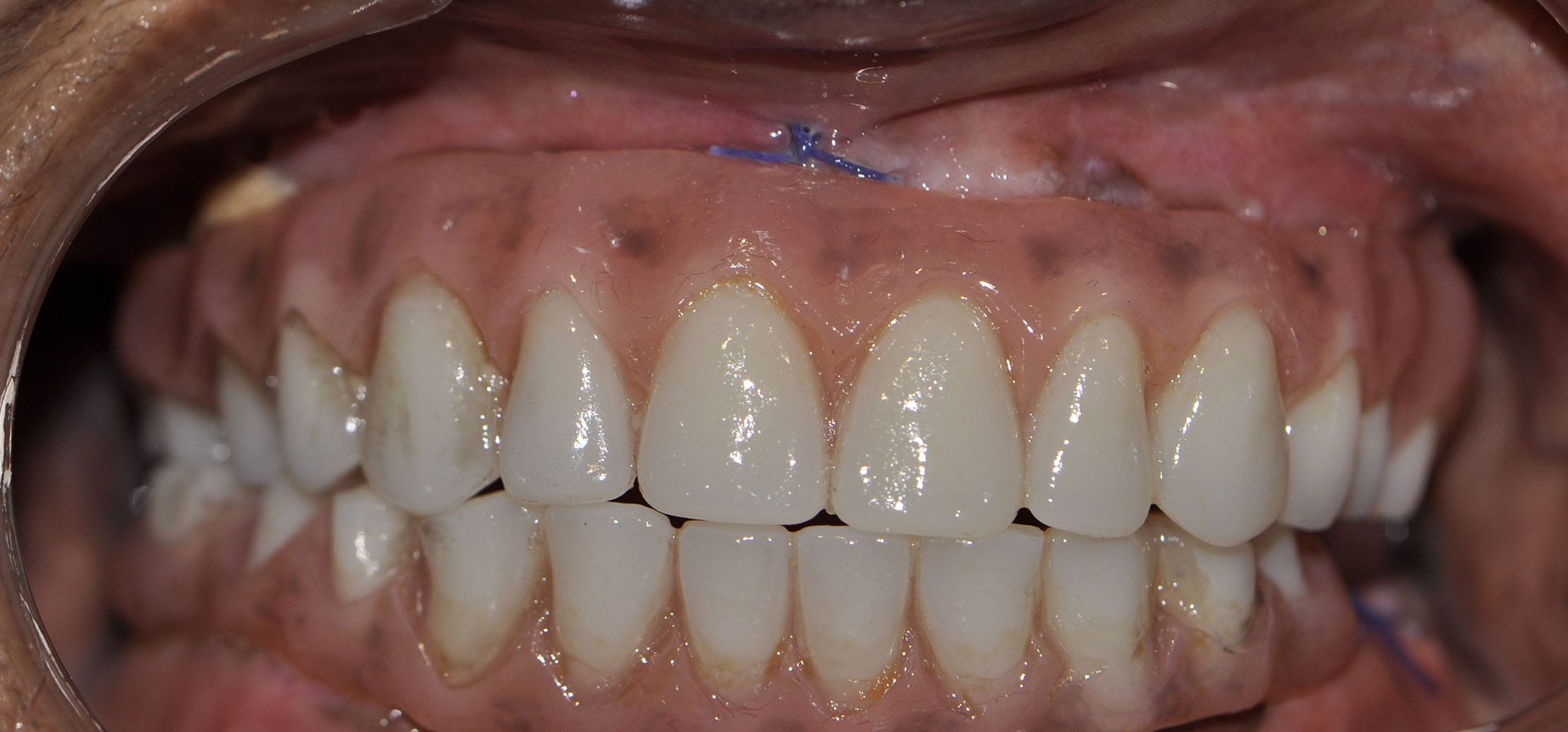 all on 4 dental implants after pic 3