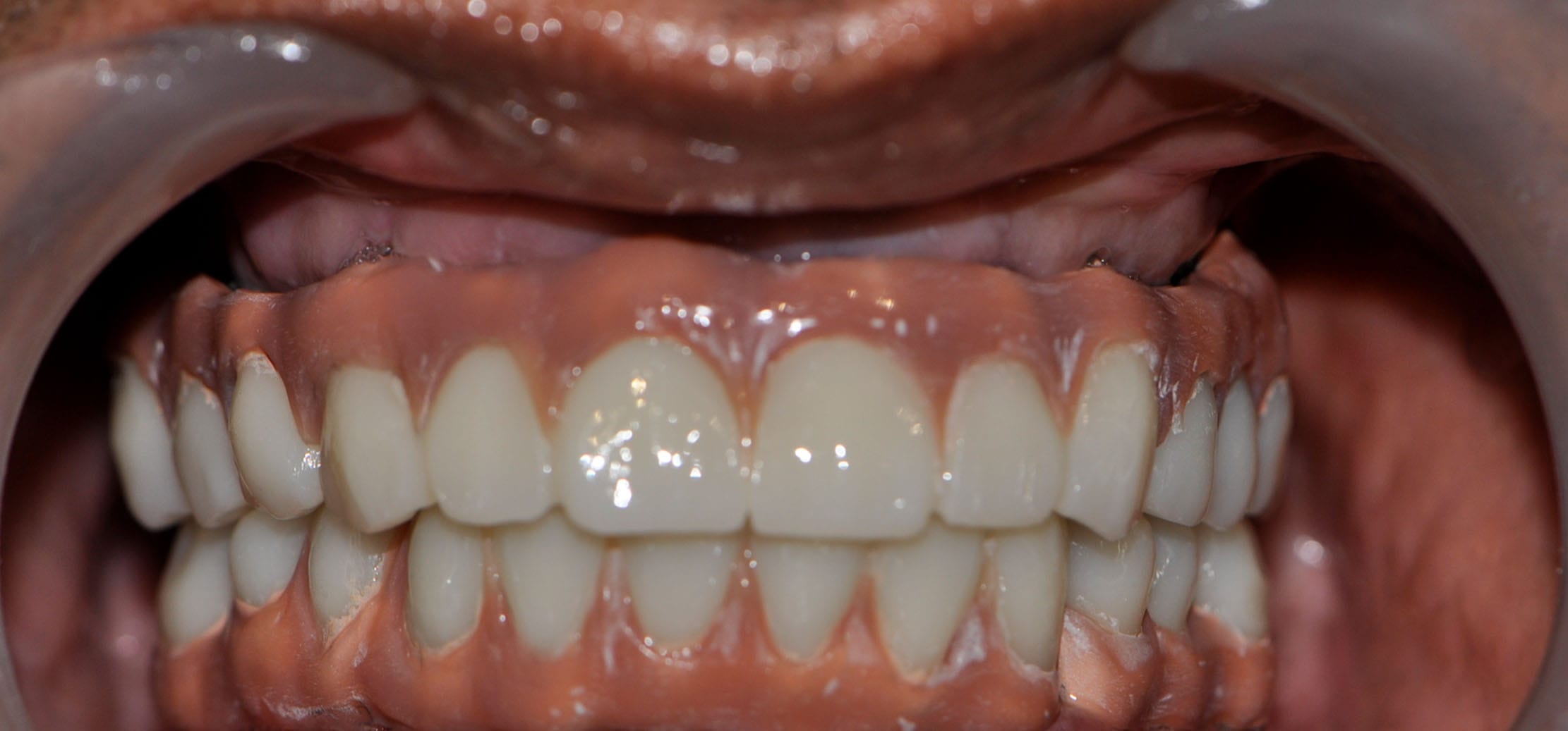 all on 6 dental implants after pic