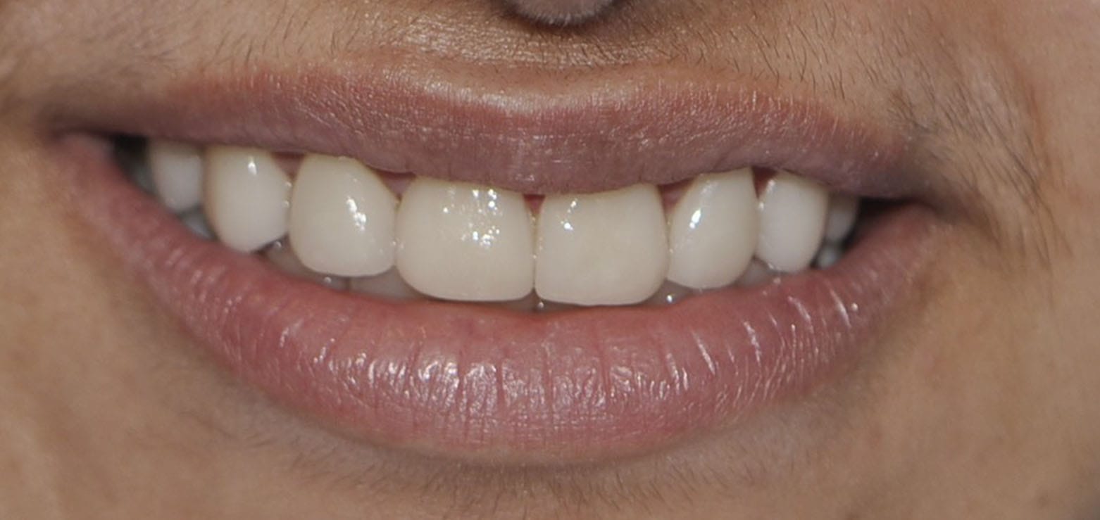 Dental Veneers After 1