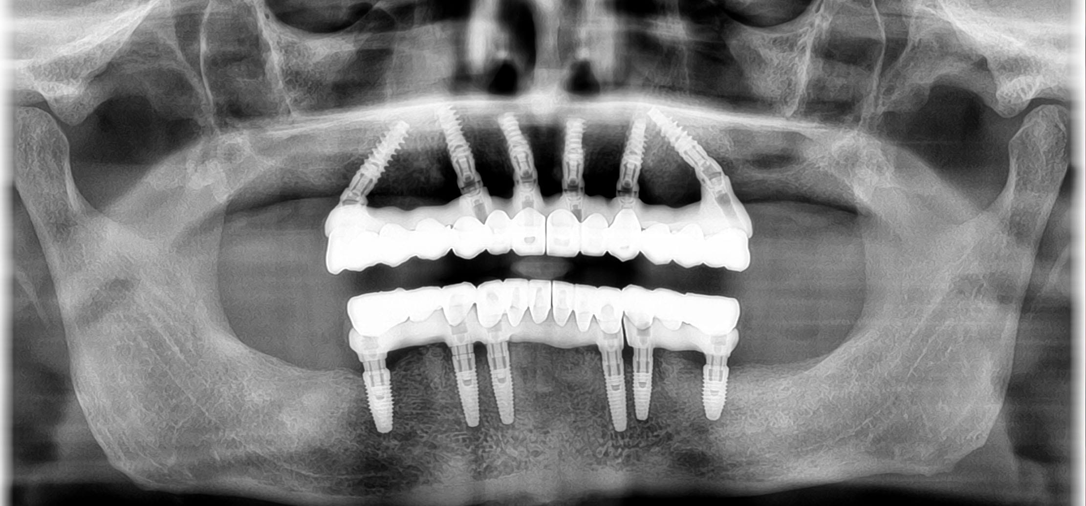 all on 6 dental implants after xray pic