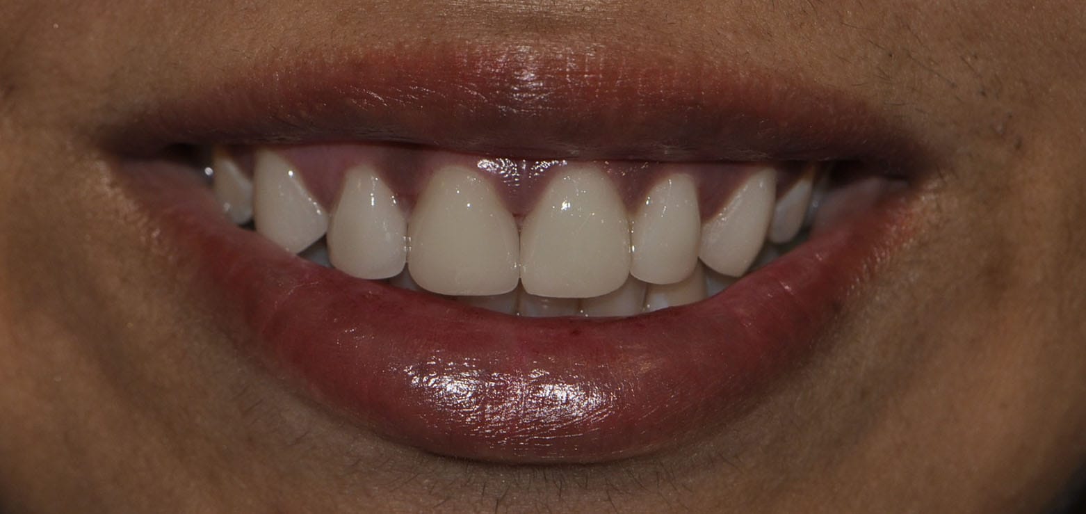 Dental Veneers After 2