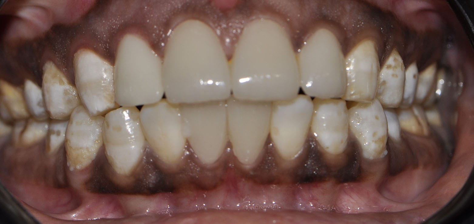 Dental Veneers After 3