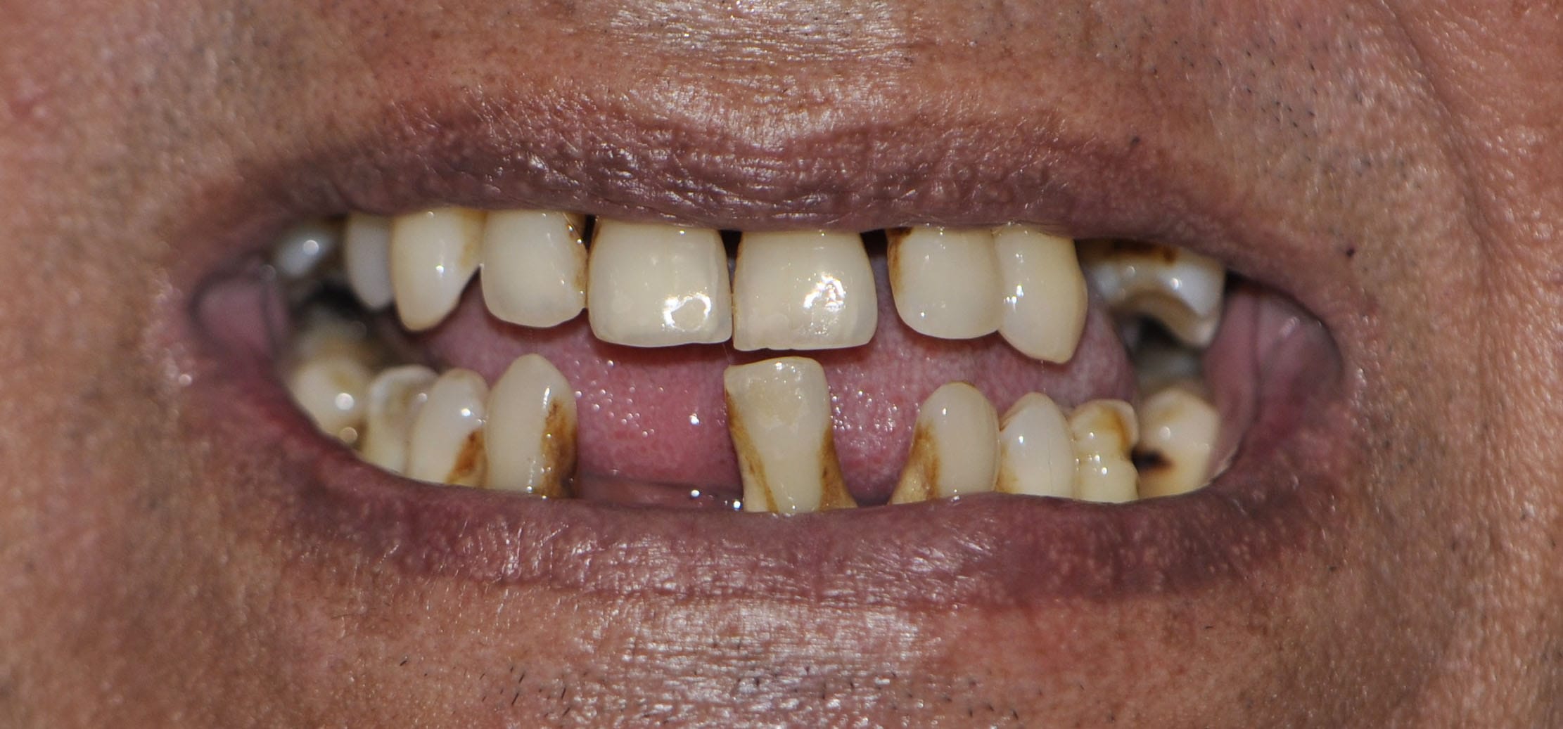 all on 4 dental implants before pic 2