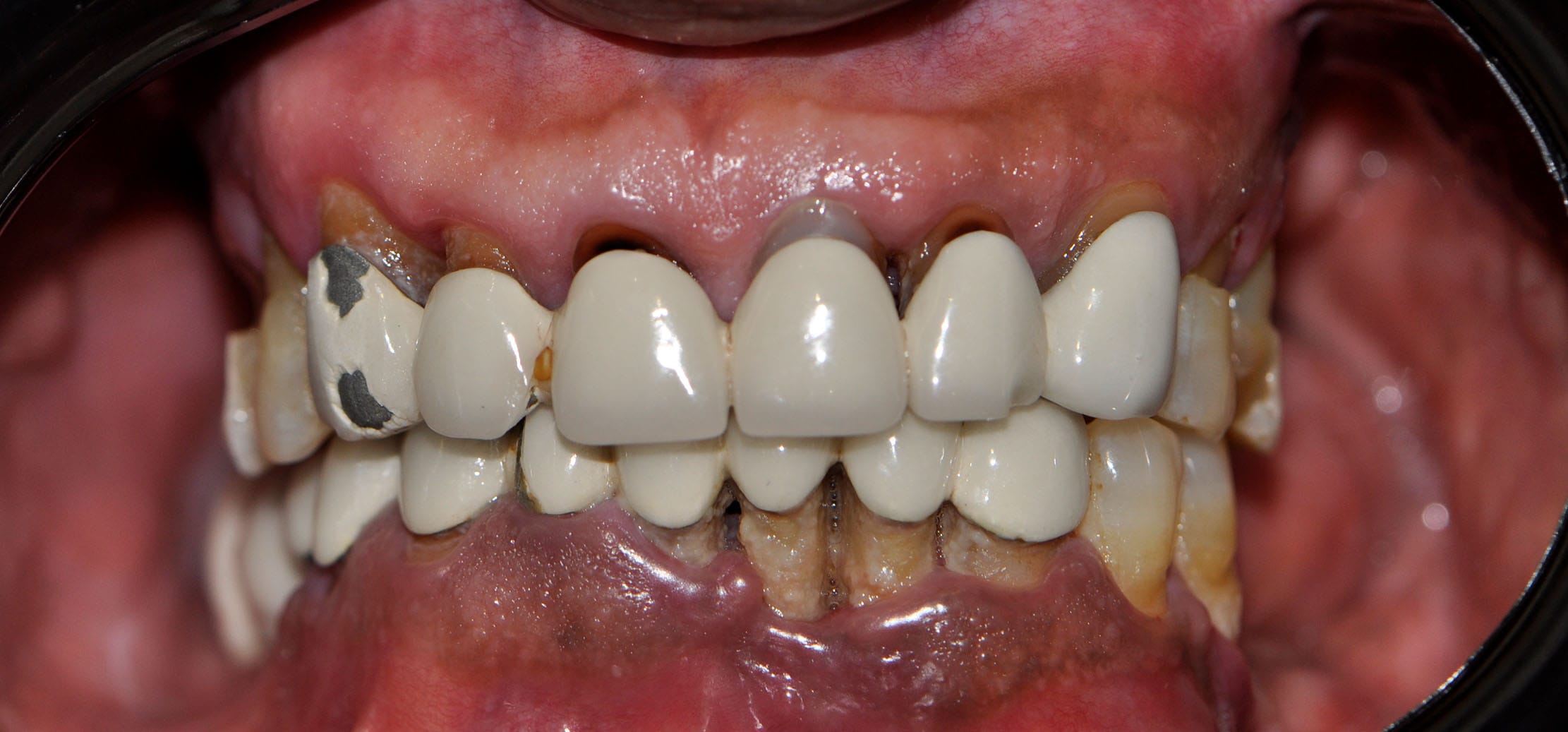 all on 6 dental implants before pic