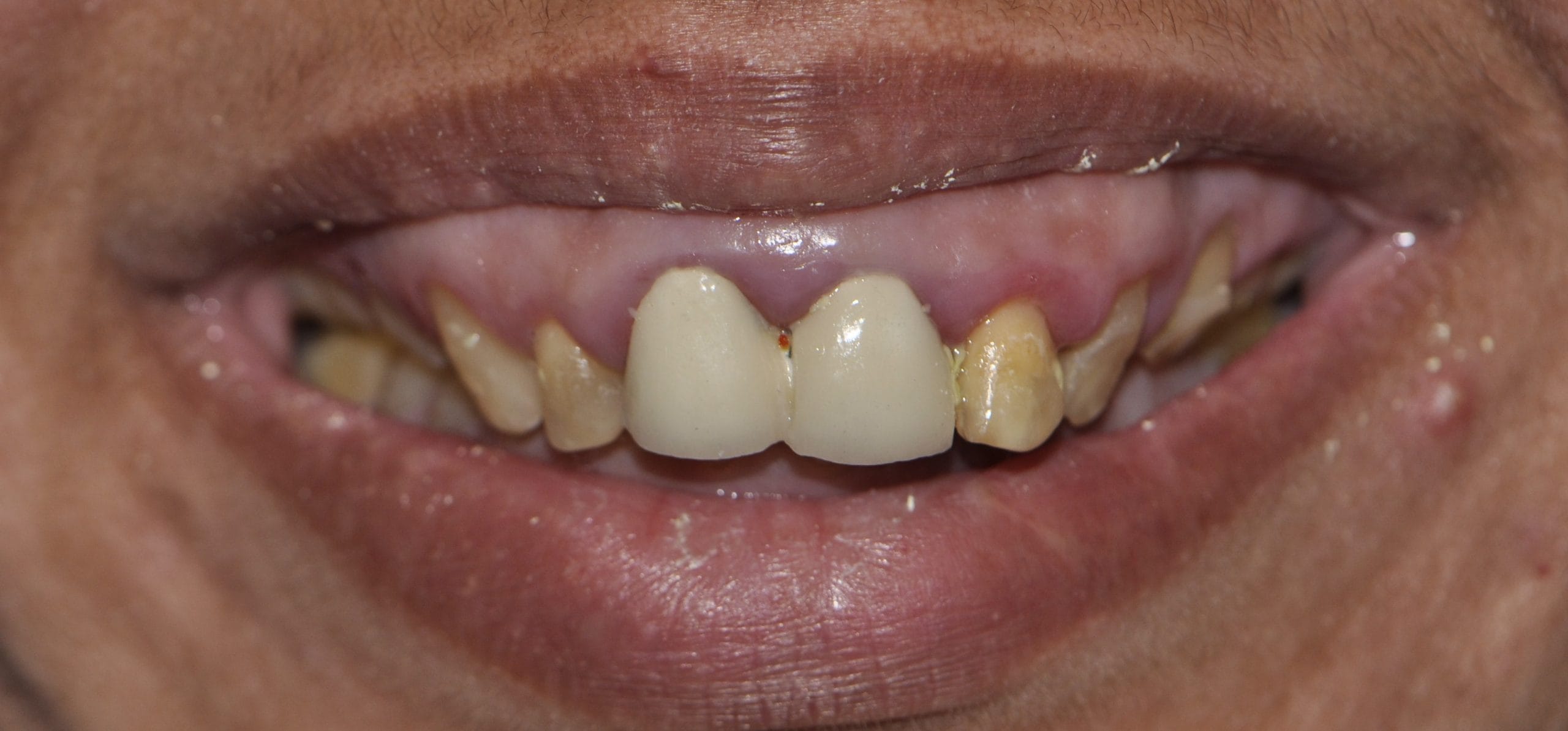 smile designing before pic