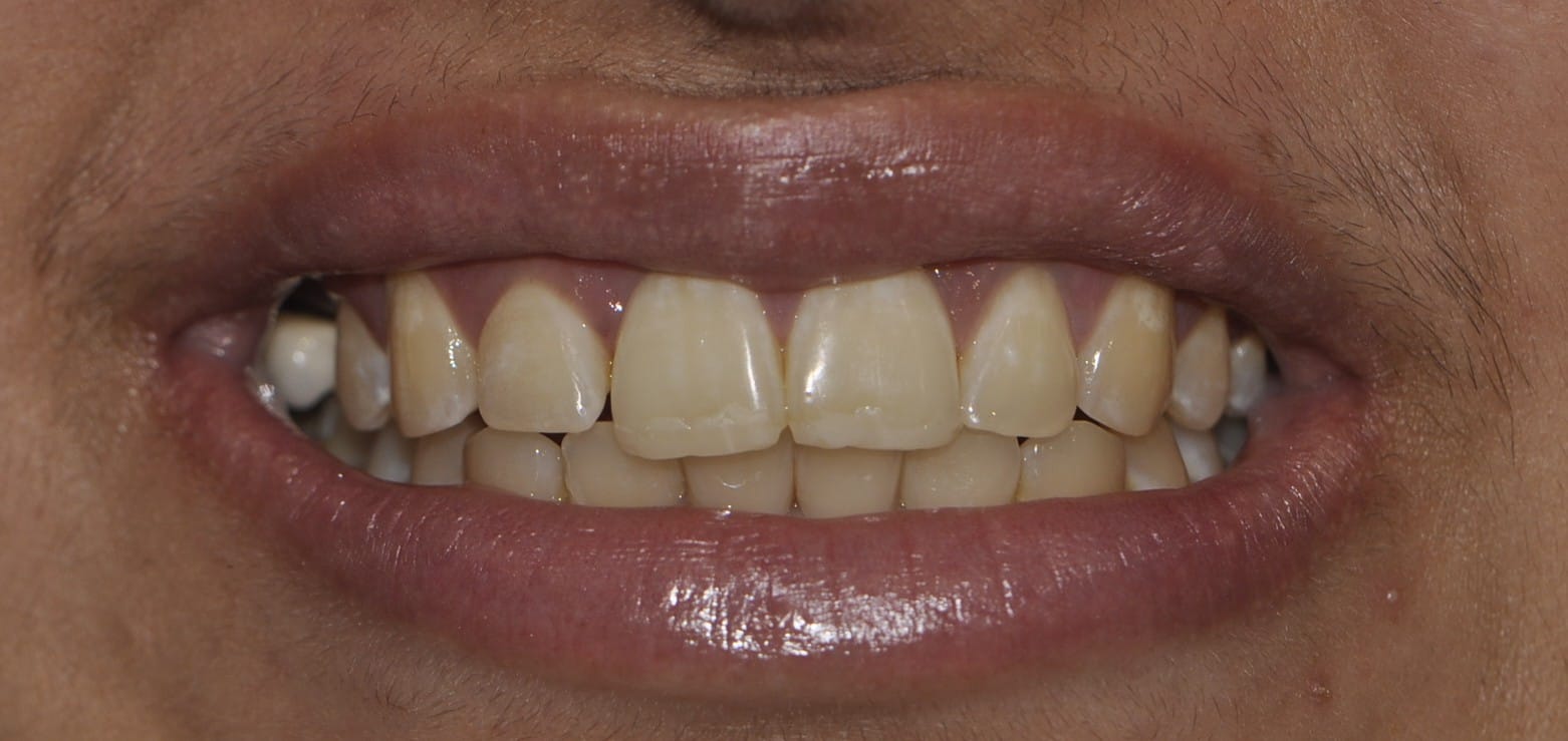 Dental Veneers Before 1