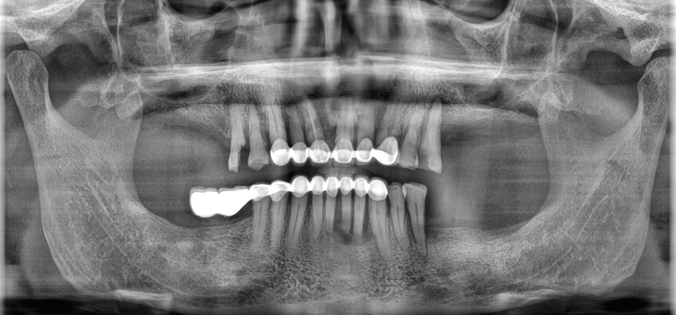 all on 6 dental implants before xray pic