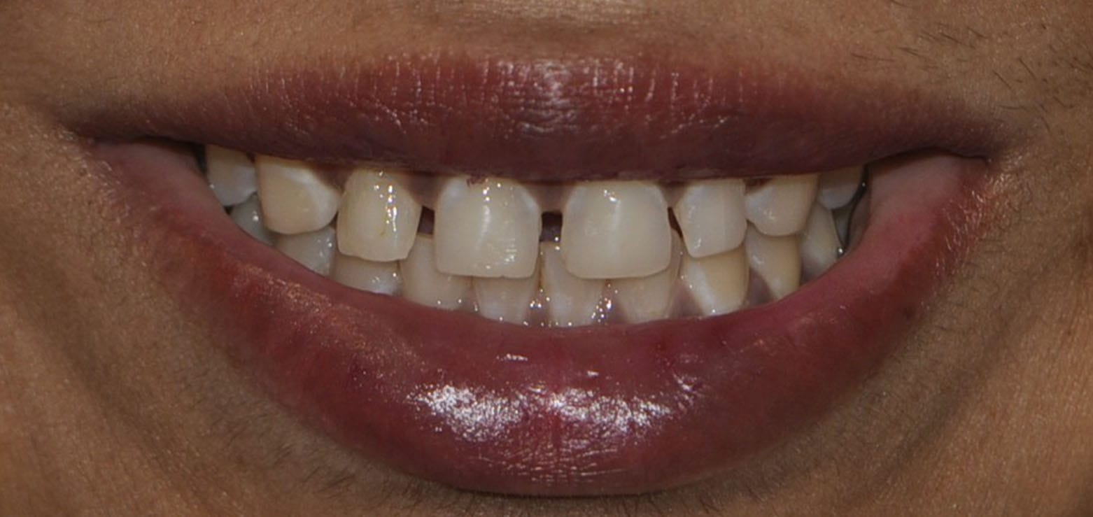 Dental Veneers Before 2