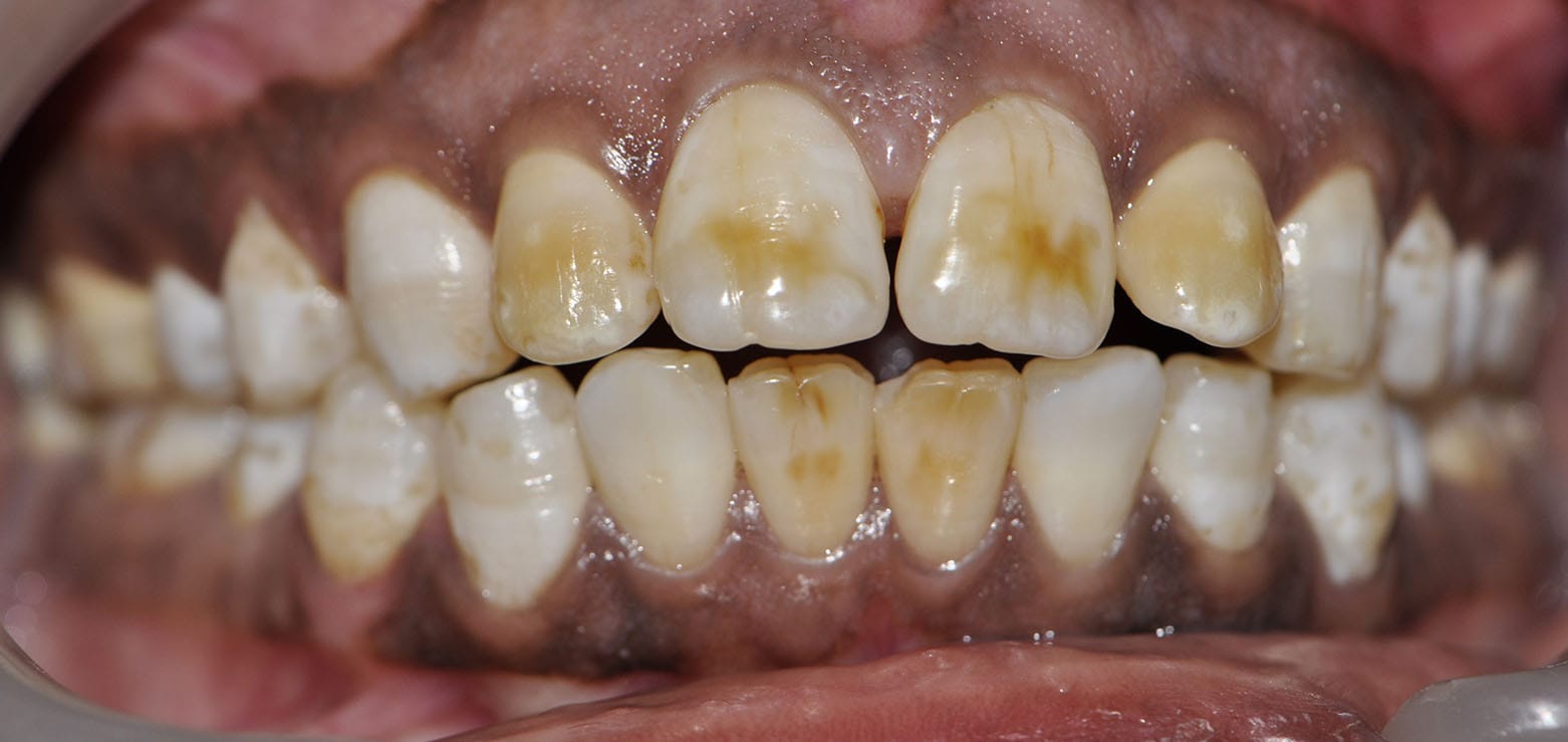 Dental Veneers Before 3